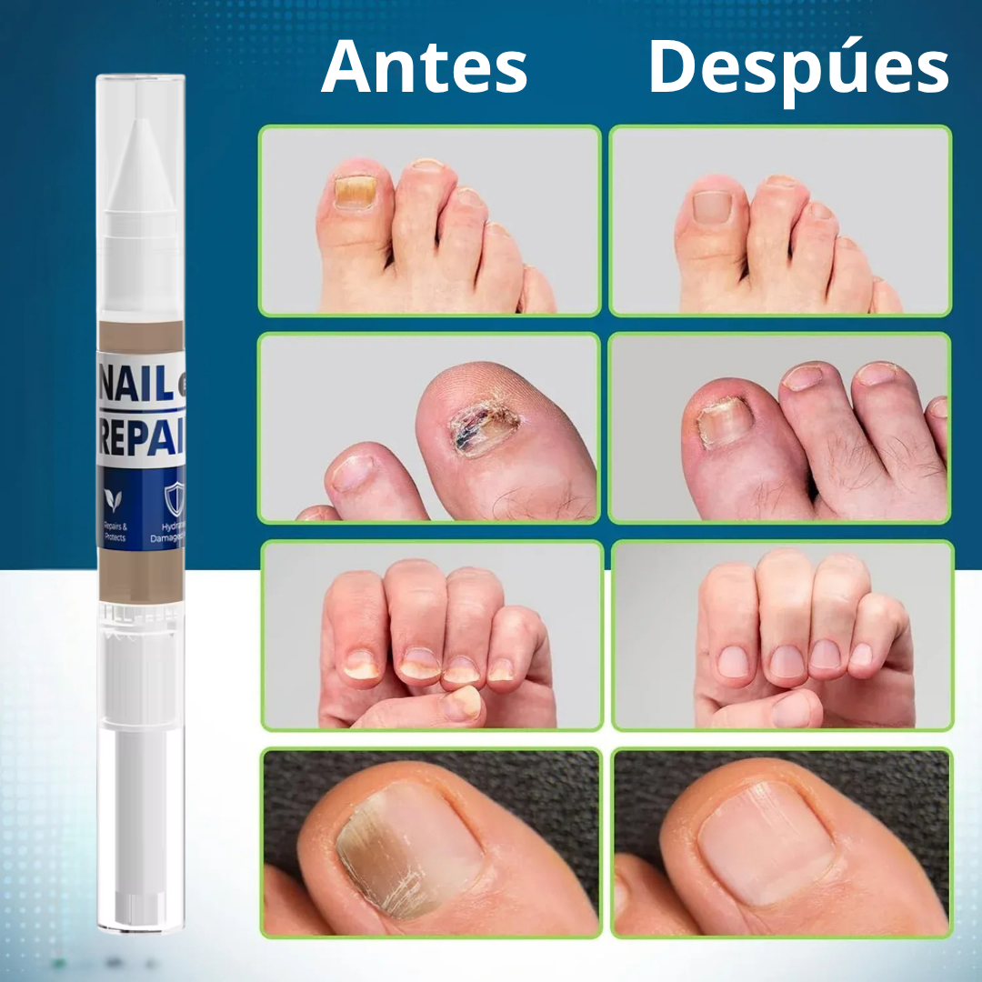 MyCurePro® Lápiz Antifúngico con Fórmula Avanzada Cl – Contra Pie de Atleta y Hongos en Uñas