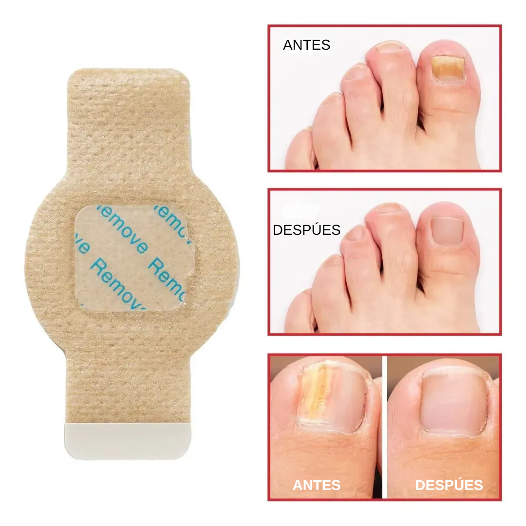 MyCurePro Parches para hongos en las uñas Resultados en 4 Semanas (21 Parches)