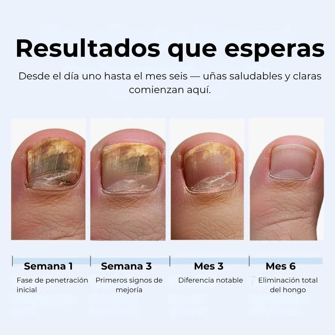 MyCurePro® · Elimina hongos en pies y manos · 7 días