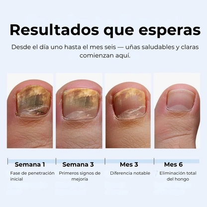 MyCurePro® · Elimina hongos en pies y manos · 7 días