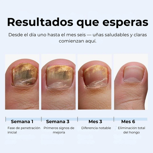 Lápiz Antifúngico MyCurePro®  con Fórmula Avanzada – Contra Pie de Atleta y Hongos en Uñas