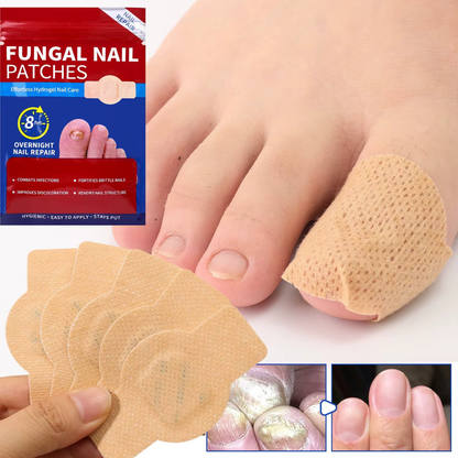 MyCurePro Parches para hongos en las uñas Resultados en 4 Semanas (21 Parches)