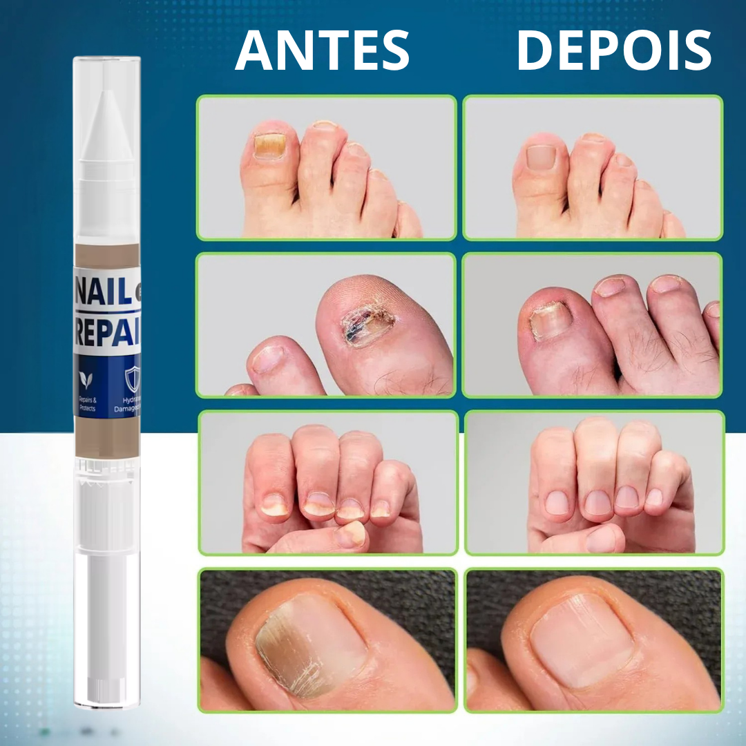MyCurePro® · Elimina Fungos nos Pés e Mãos · 7 Dias