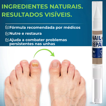 MyCurePro® · Elimina Fungos nos Pés e Mãos · 7 Dias