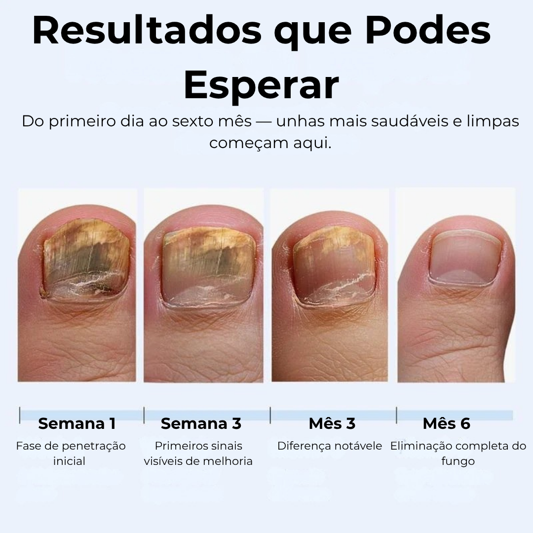 MyCurePro® · Elimina Fungos nos Pés e Mãos · 7 Dias