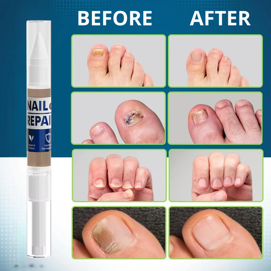 MyCurePro® · Clears Foot & Hand Fungus · 7 Days