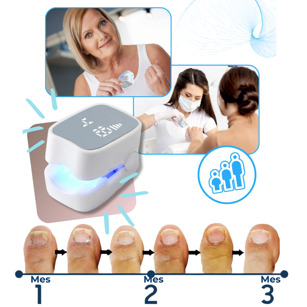 MyCurePro® Eliminador láser antihongos