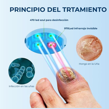 MyCurePro® Eliminador láser antihongos