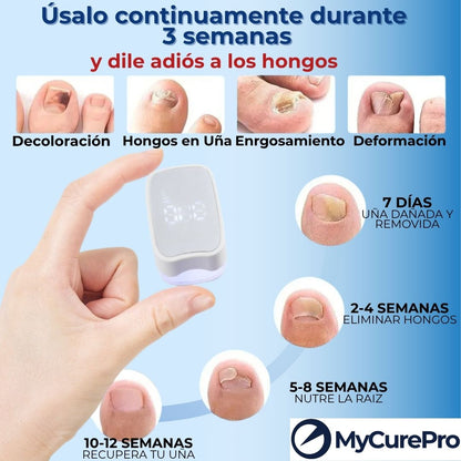 MyCurePro® Eliminador láser antihongos